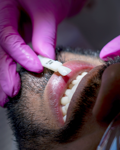 Blanqueamiento dental